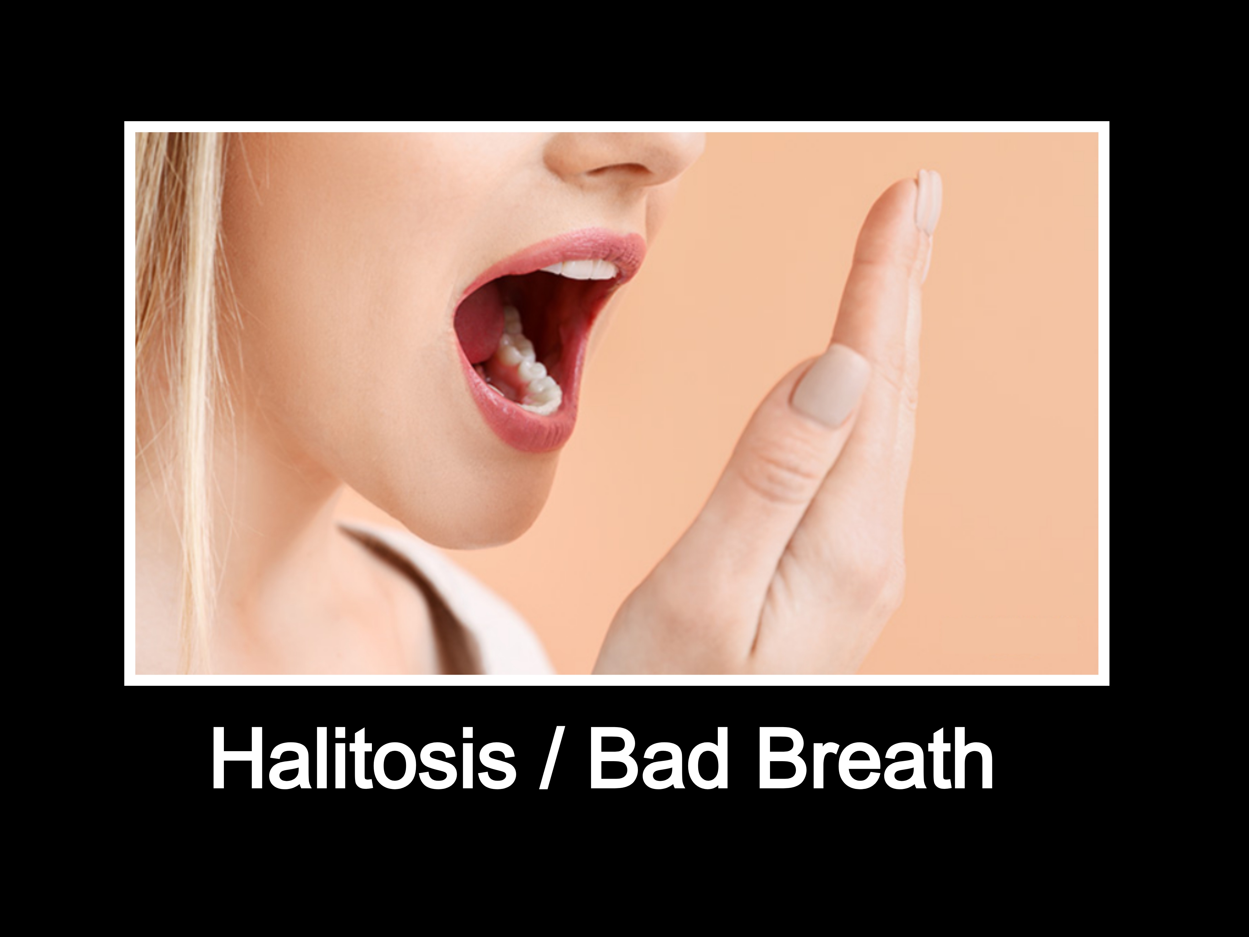 Halitosis - Bad breath - Bad odor from mouth