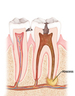 Dental abscess treatment, tooth pain while chewing