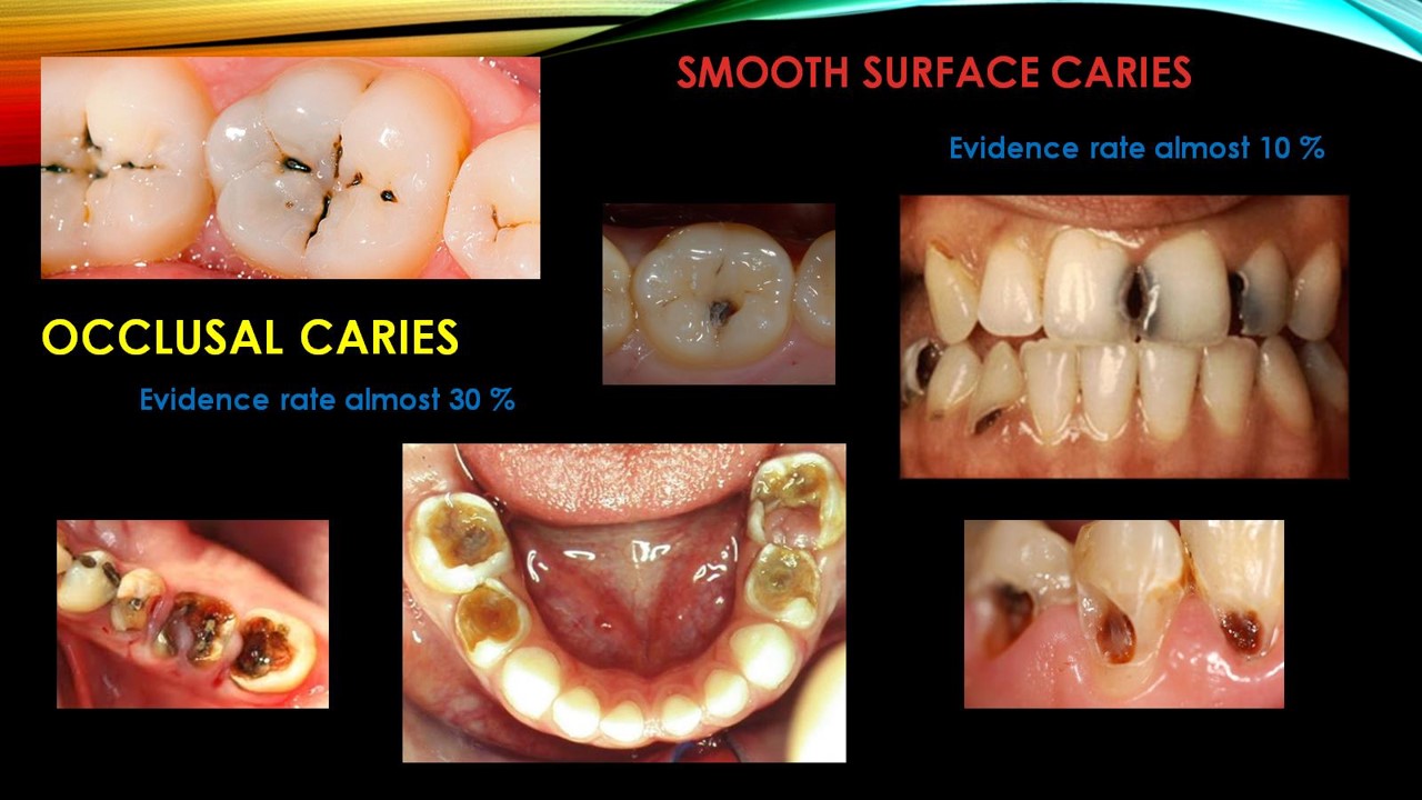 Caries Extent 1