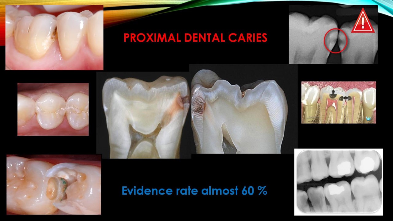 Caries Extent 2