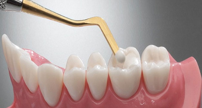 Composite fillings 2