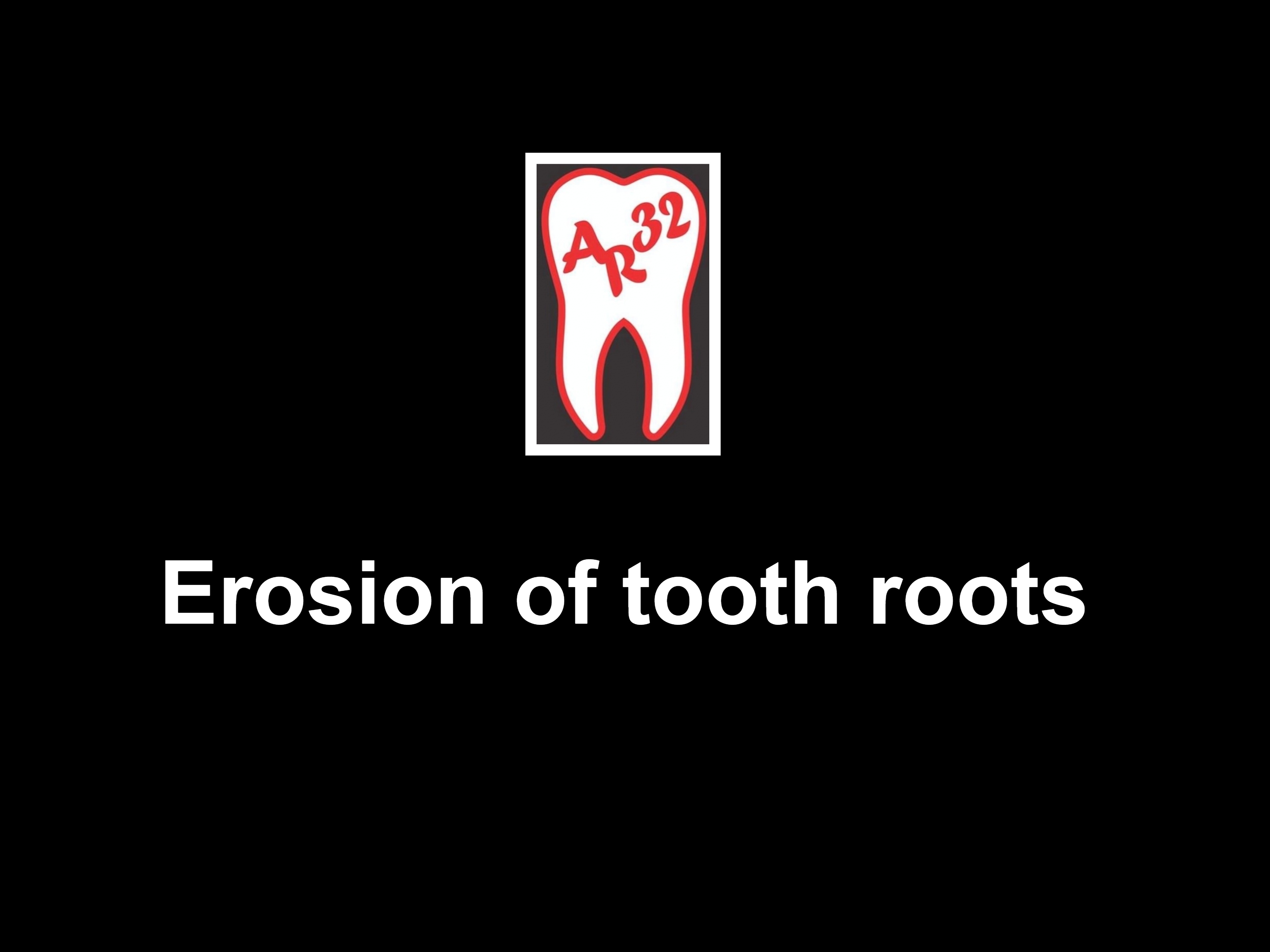Erosion of tooth roots and cervical abrasion clinical representation