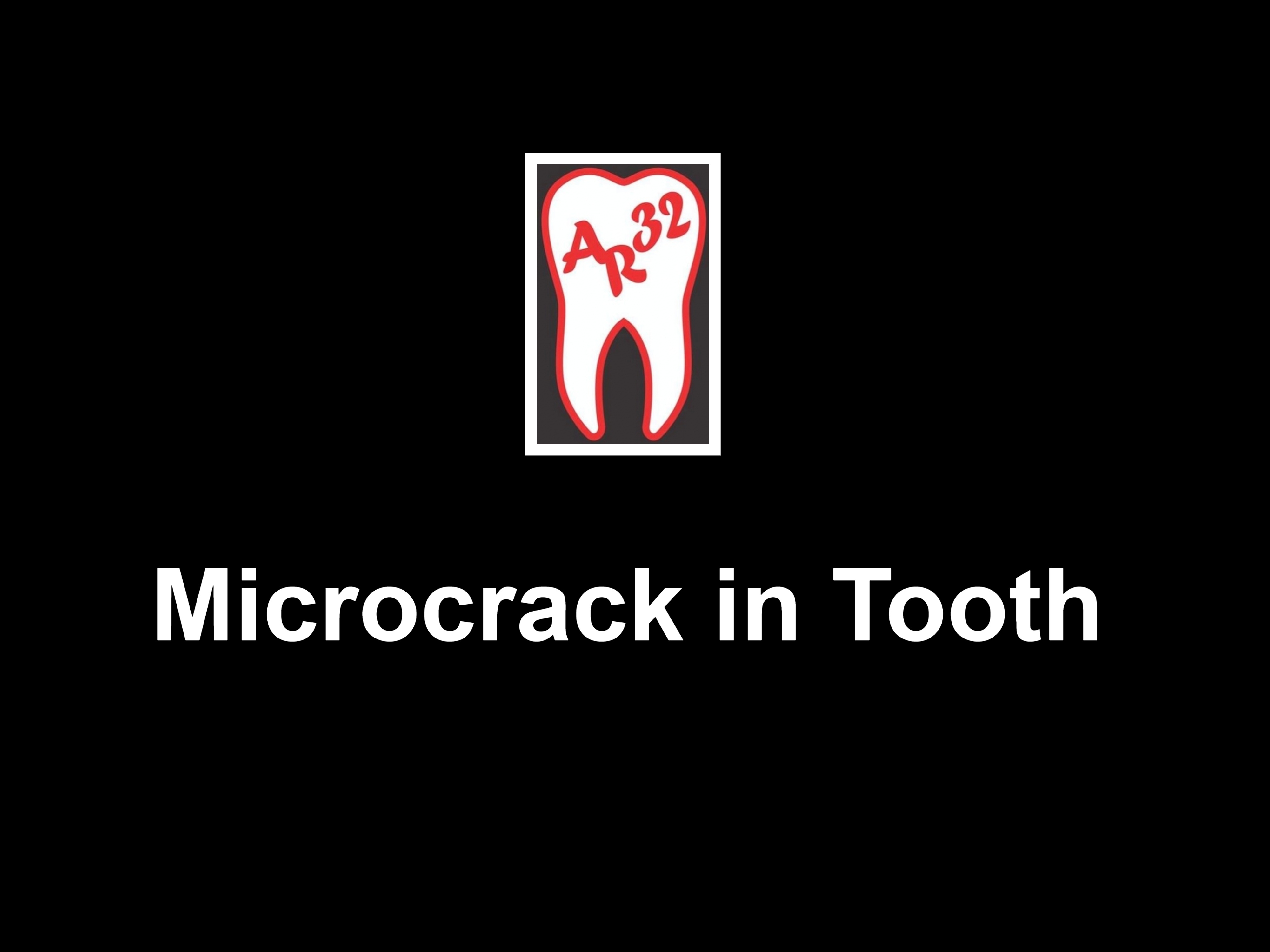 Microcrack in tooth and craze lines clinical representation