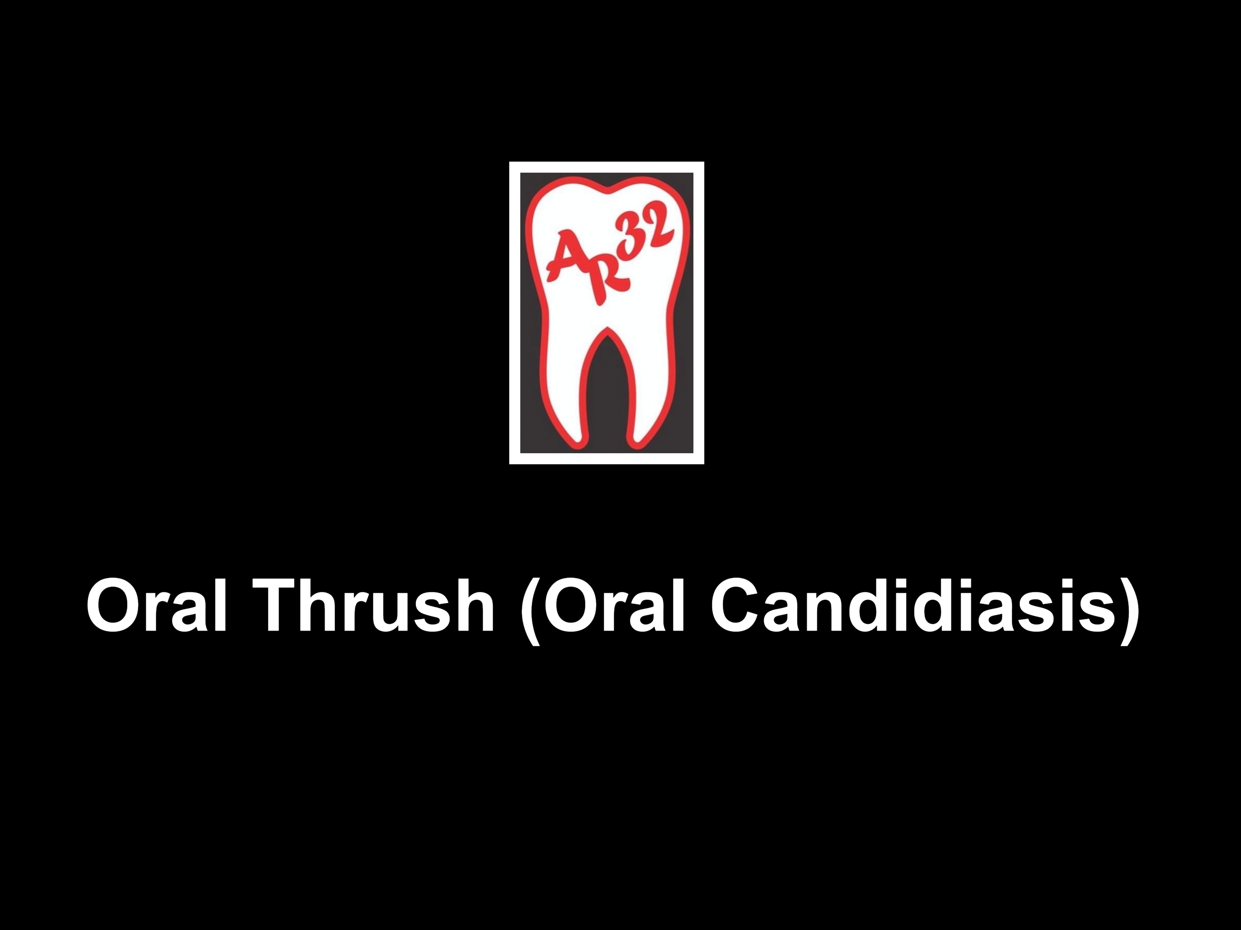 Oral thrush white patches candidiasis clinical representation