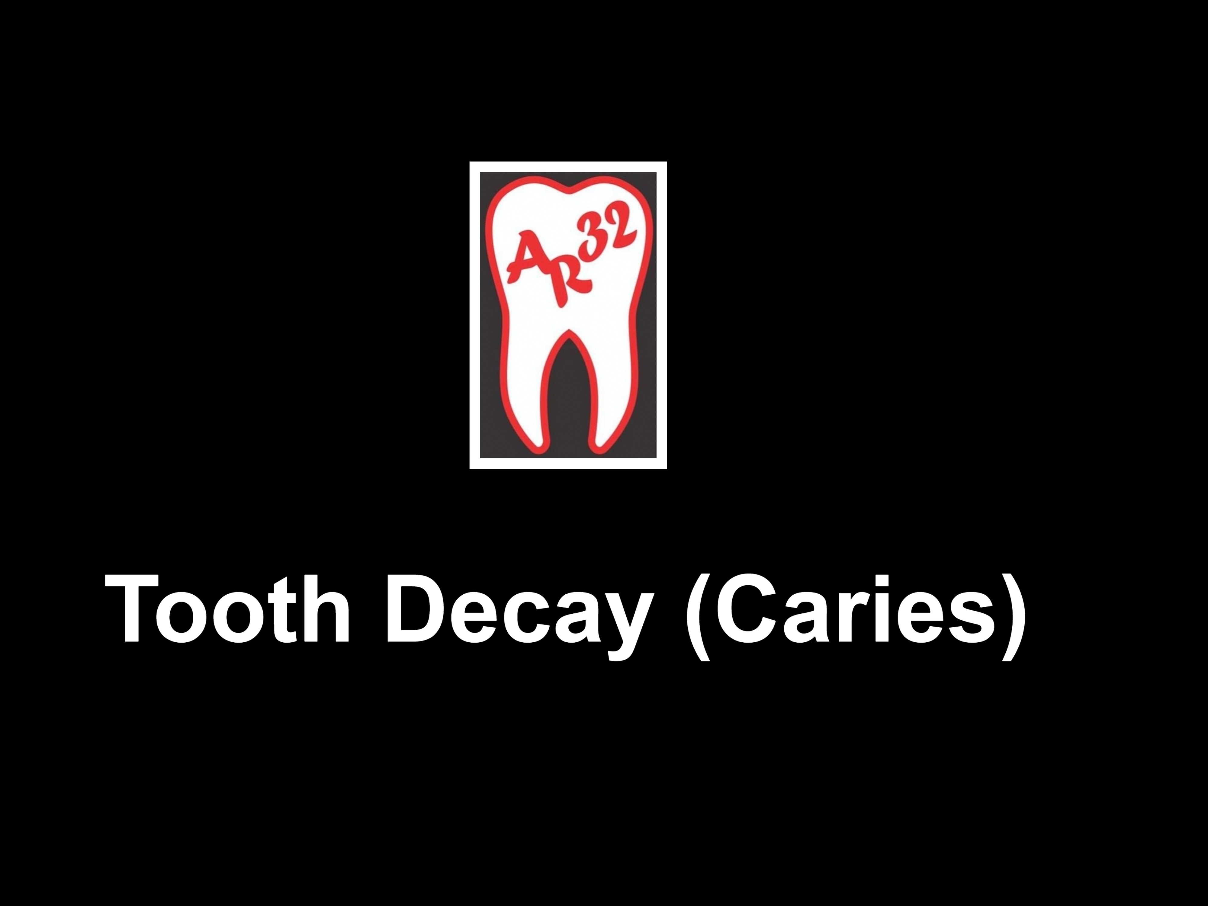 Tooth decay dental caries cavity clinical representation