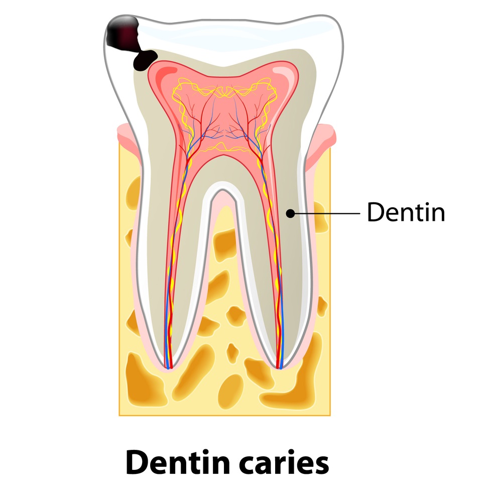 DECAY IN DENTIN