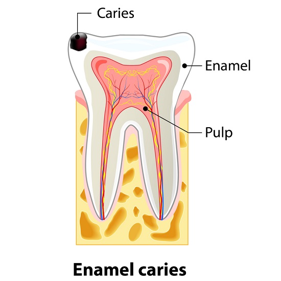 Decay in enamel treatment