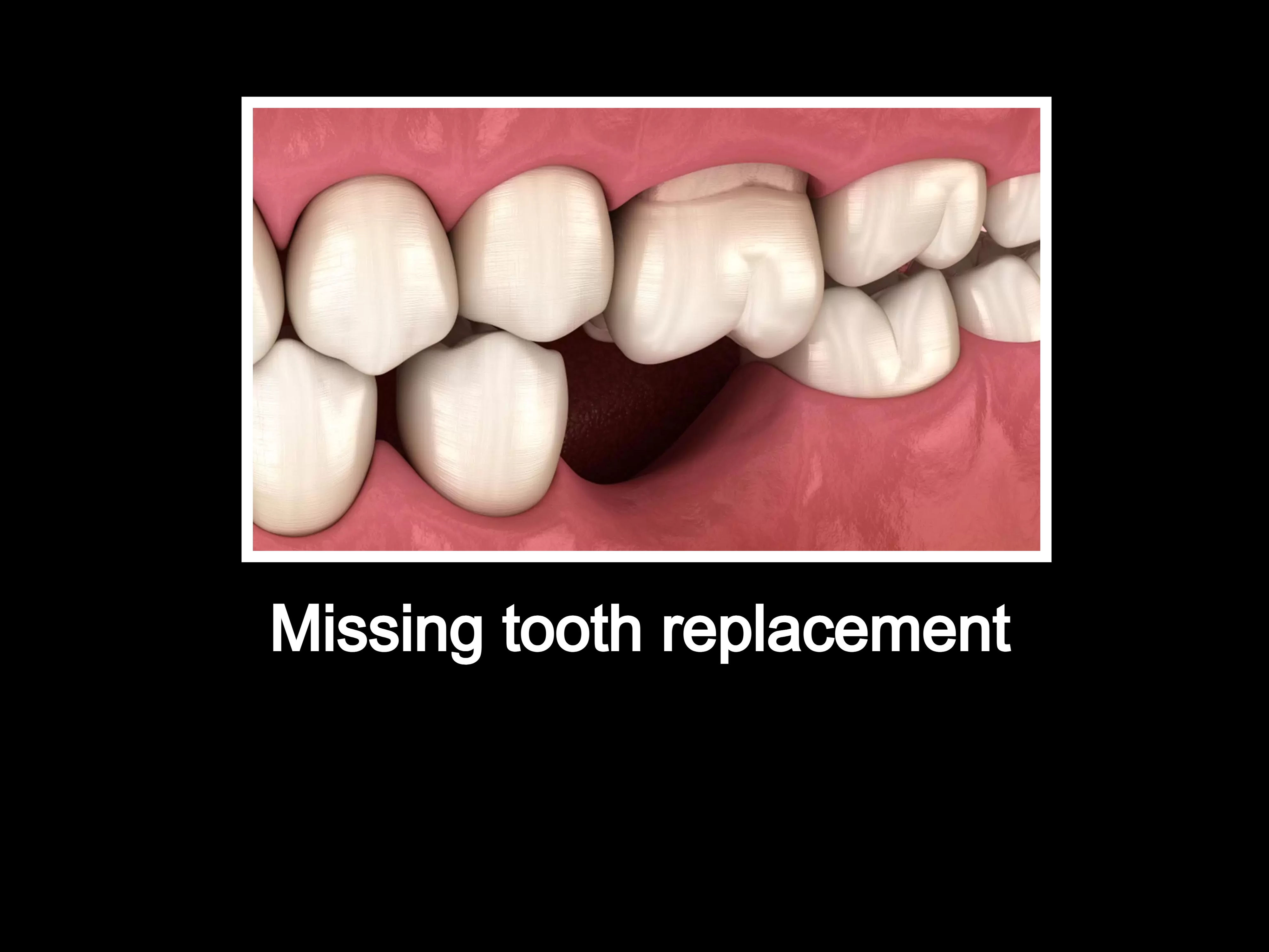 Missing tooth replacement options, how to replace a fallen tooth