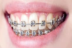 Braces / Orthodontic Treatment