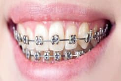 Braces / Orthodontic Treatment in Aundh