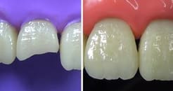 Dental Restoration in Ganj peth