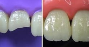 Dental Restoration in Chimbali