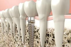 Dental Implant in Dighi