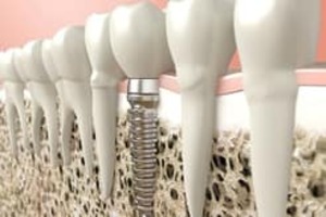 Dental Implant in Shivaji nagar