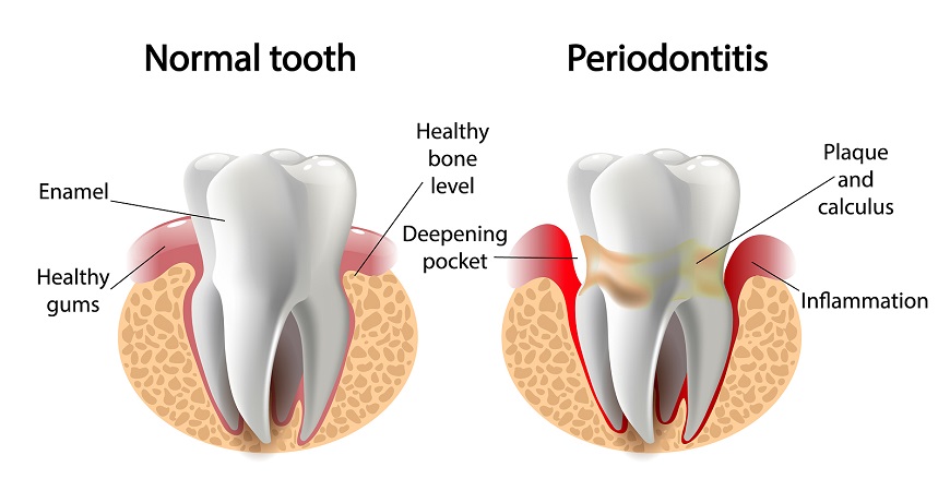 Gum Problems, Bleeding in gums, Swelling in gums