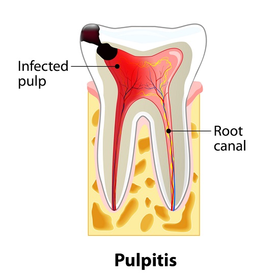 Decay in Pulp Treatment