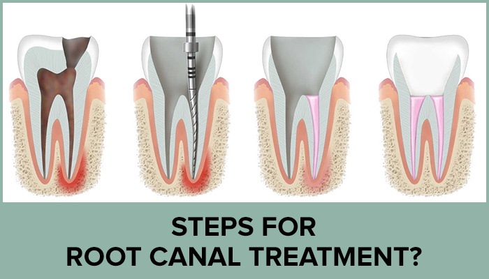 Endodontist doctors / Root canal specialists in Kharadi Endodontist doctors / Root canal specialists in Kharadi