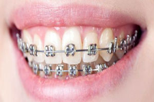 Dental Braces / Orthodontic Treatment