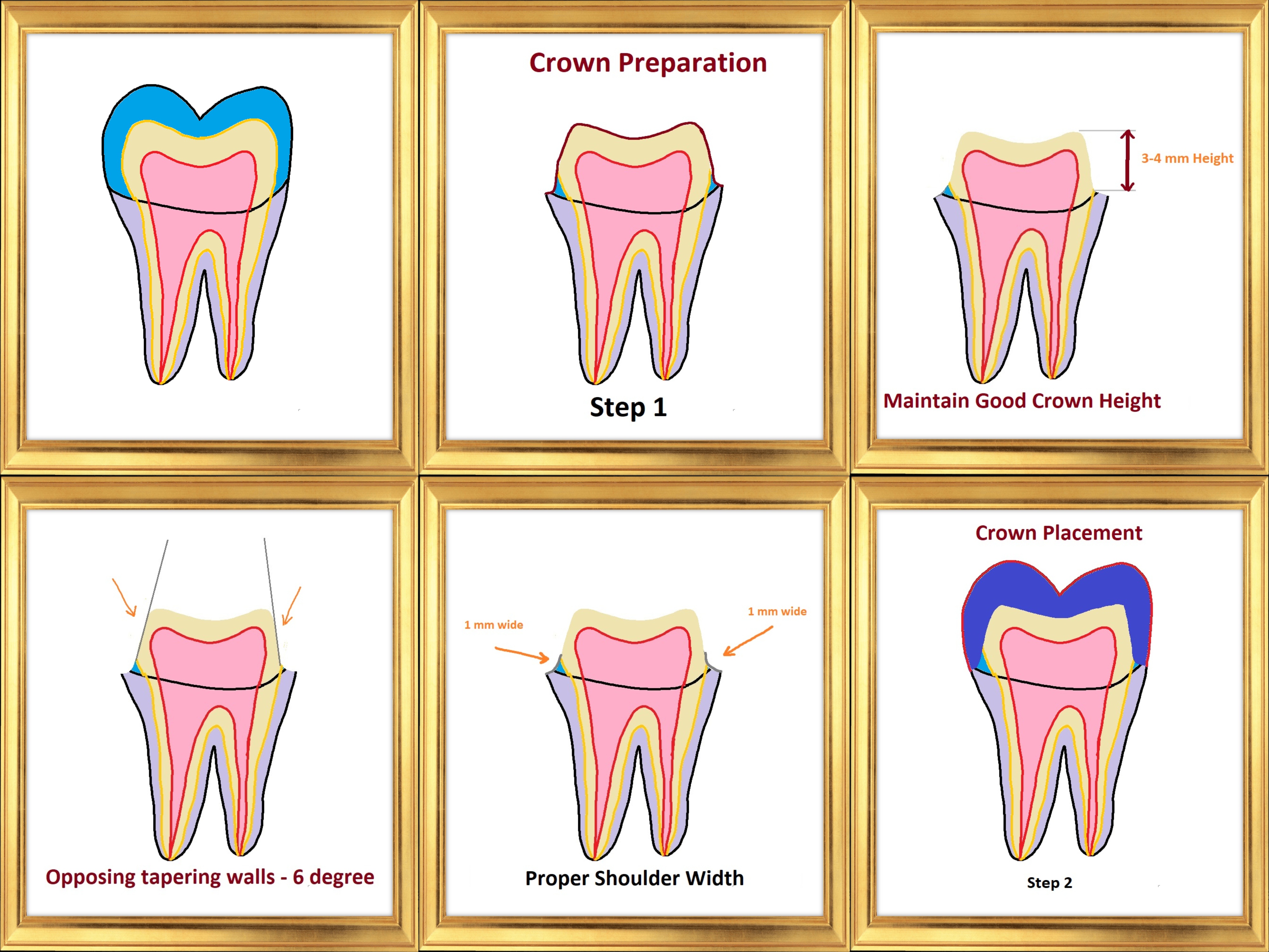 Crown Preparation Basics