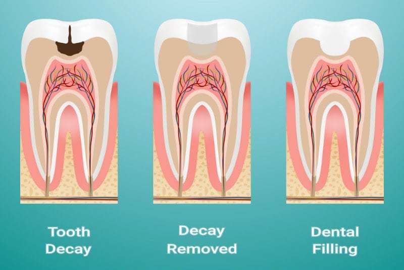 Composite Restoration Basics