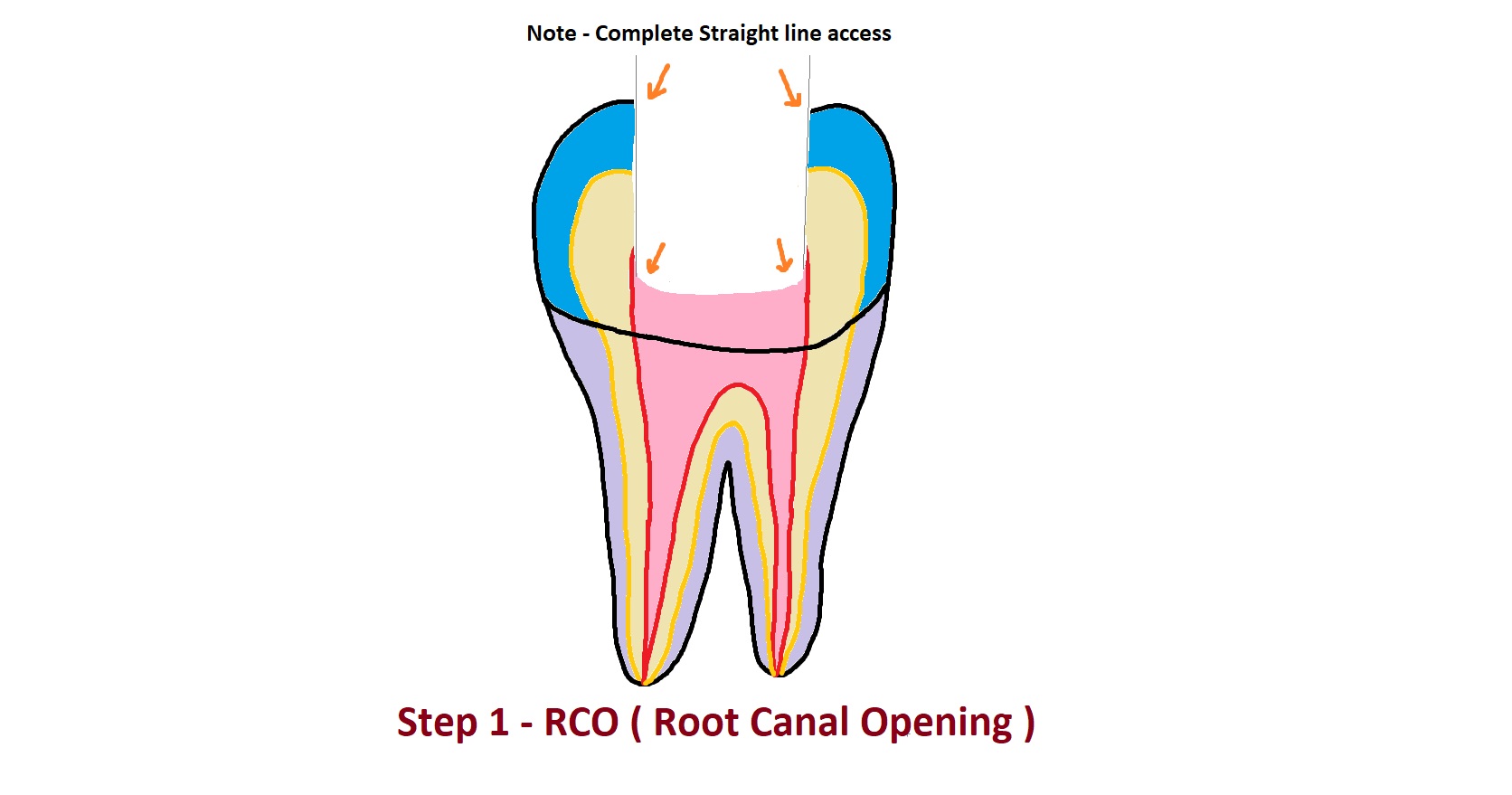 Root Canal Opening