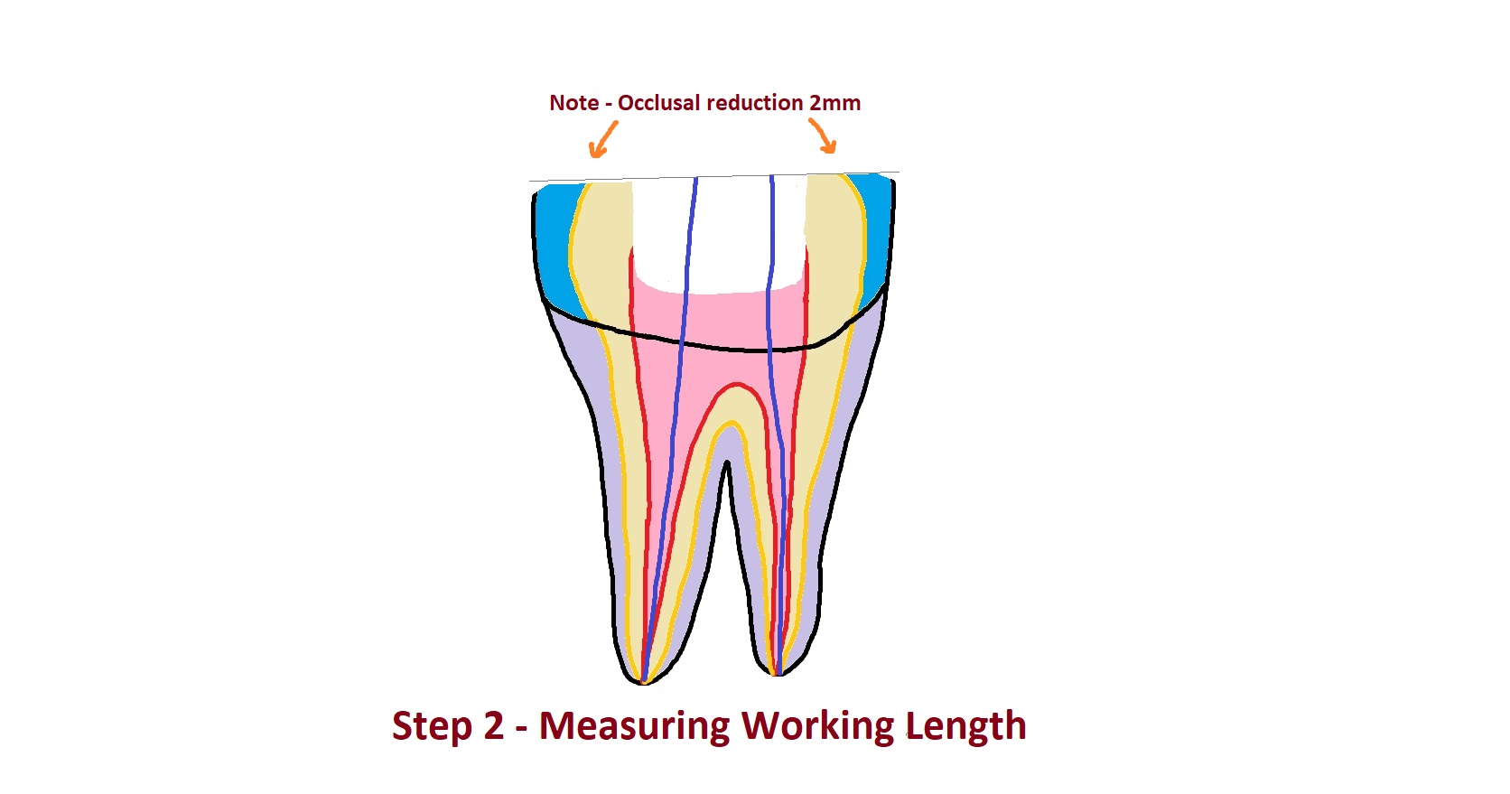 Working Length Measurement