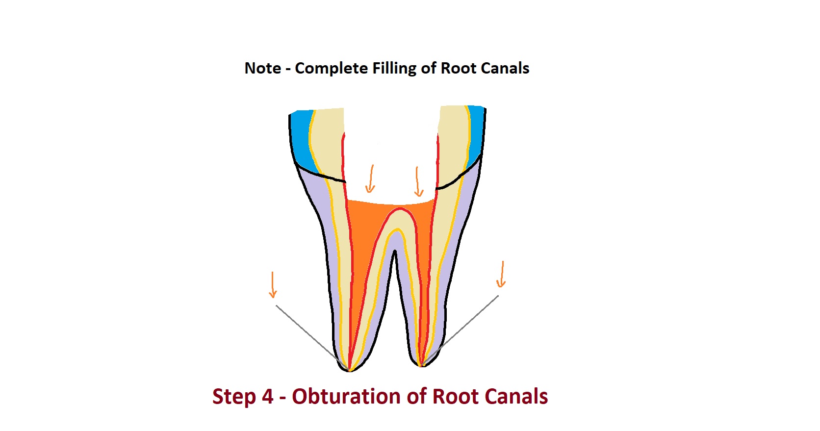 Obturation of Root Canals
