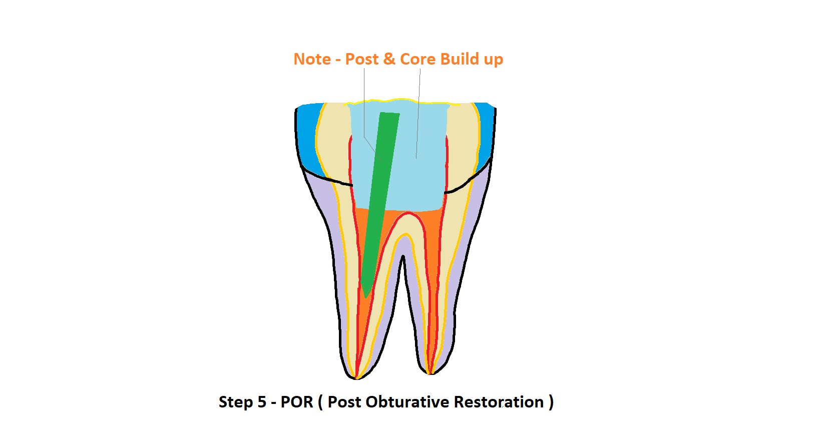 Post Obturative Restoration