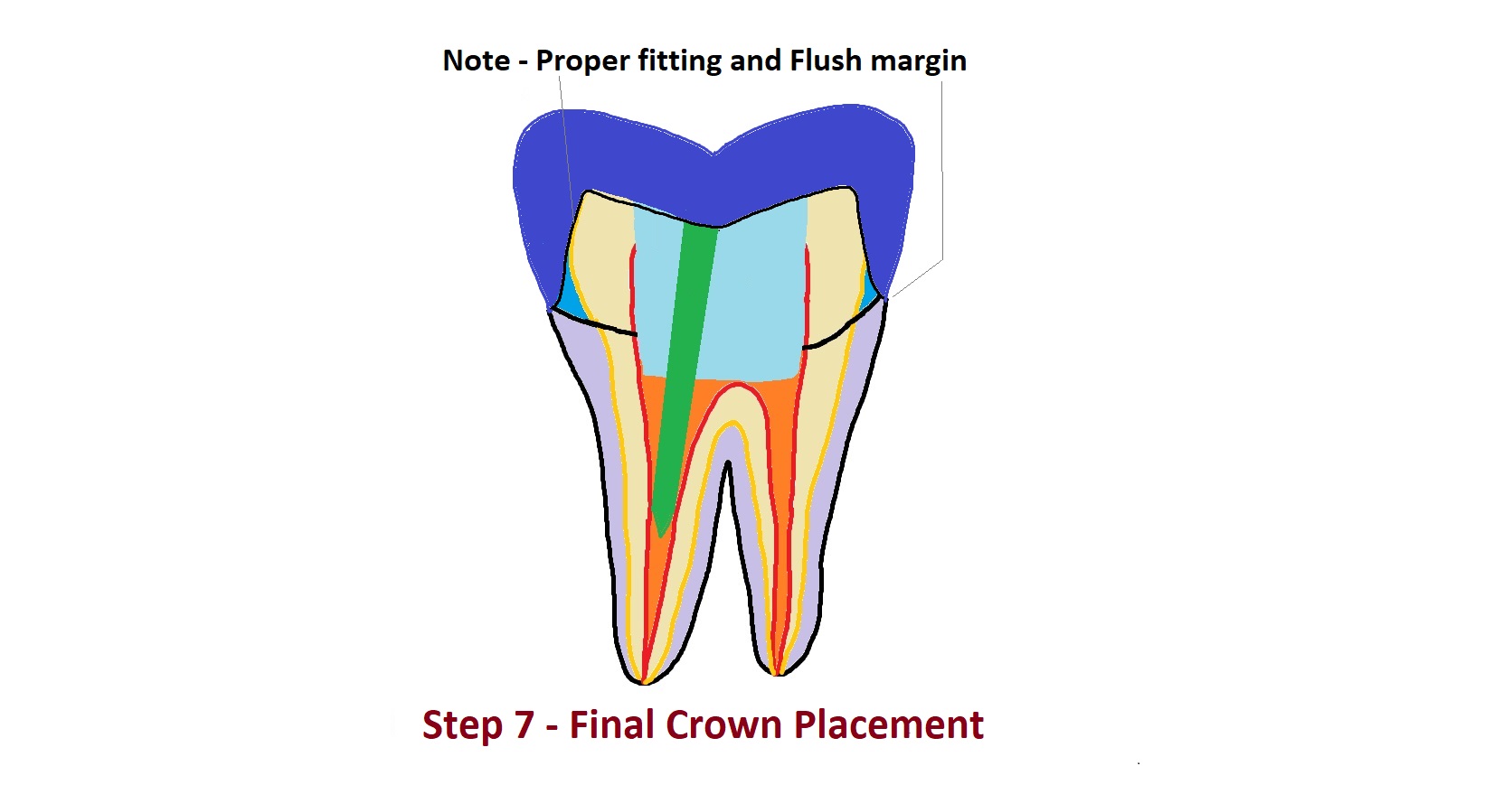 Final Crown Placement