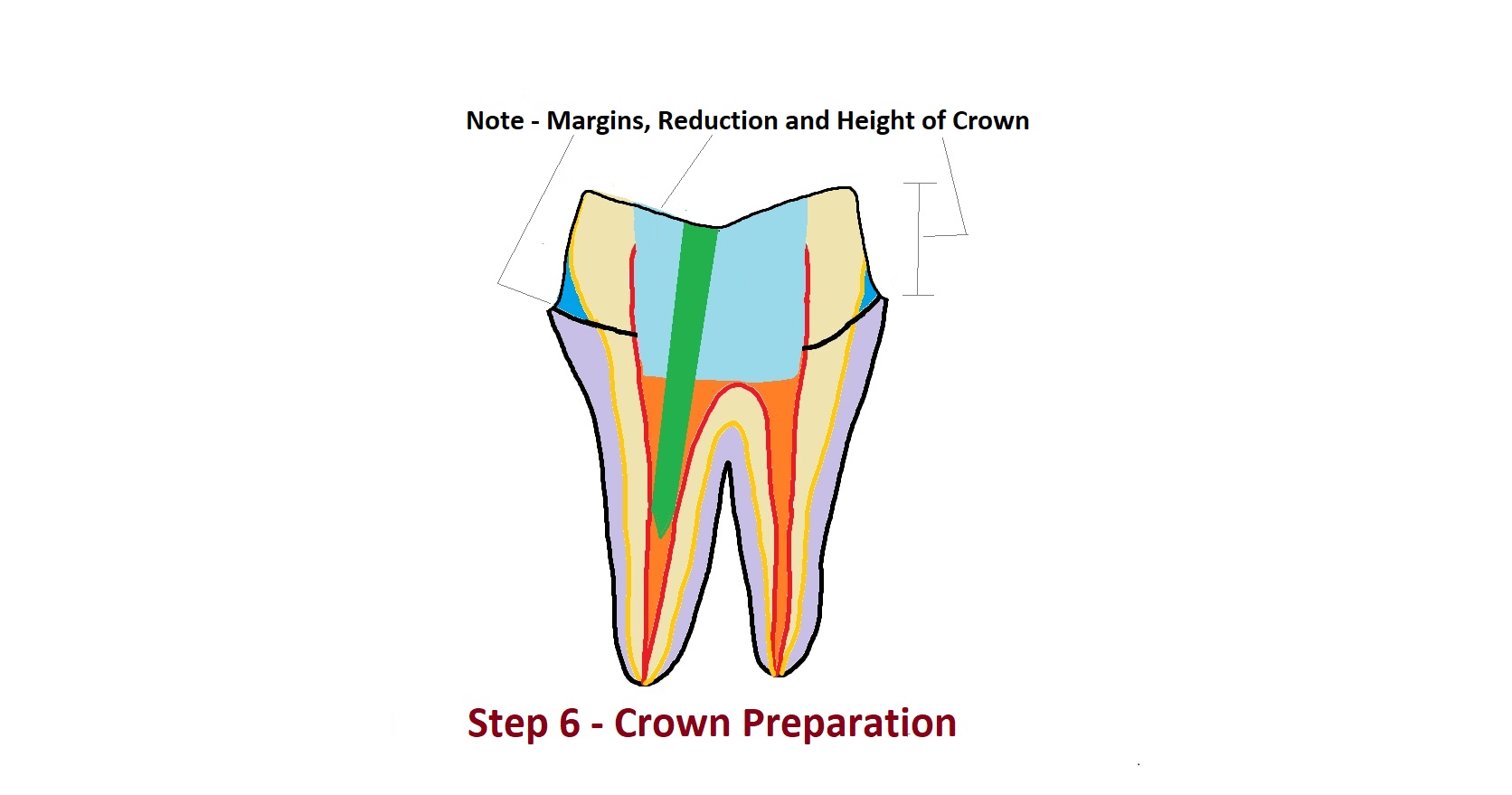 Crown Preparation